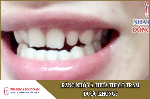 răng nhỏ và thưa thì có trám được không