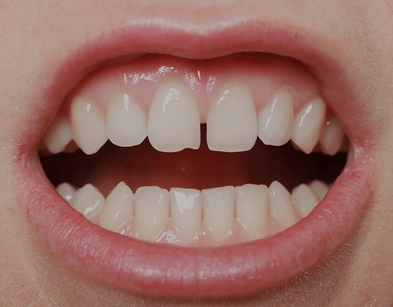 Răng thưa nhỏ có thể khắc phục bằng phương pháp bọc răng sứ