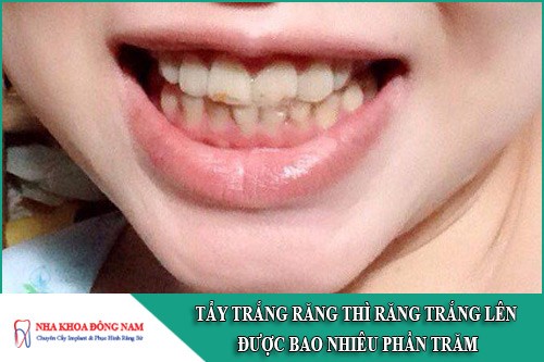 tẩy trắng răng thì răng trắng lên được bao nhiêu phần trăm