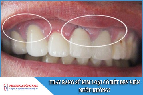 thay răng sứ kim loại có hết đen viền nướu không