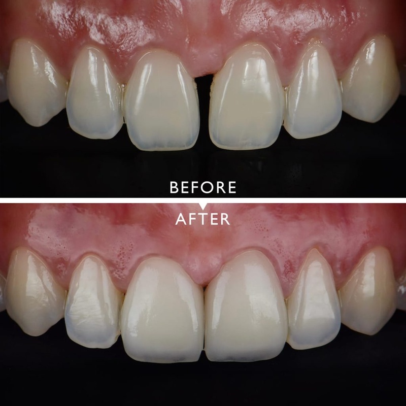Trám răng Composite cho răng cửa thưa nhỏ