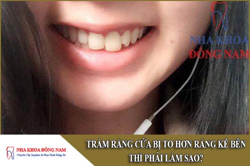 trám răng cửa bị to hơn răng kế bên thì phải làm sao