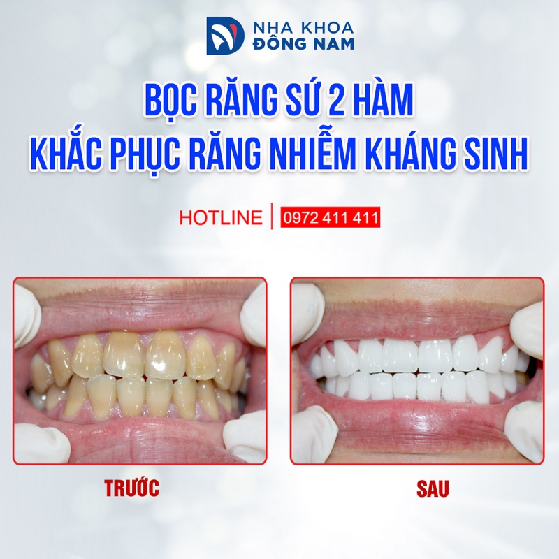 Trồng răng sứ thẩm mỹ cho răng bị nhiễm kháng sinh