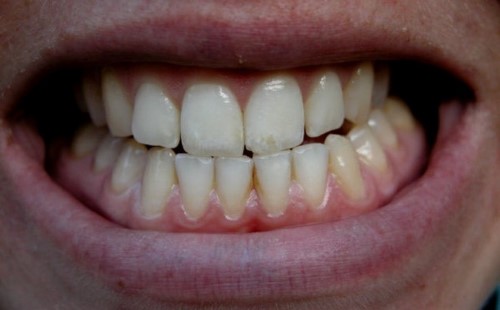 14 tuổi có bọc răng sứ được không 1