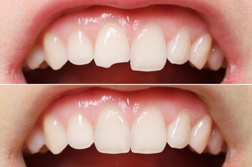 trám răng composite cho răng bị mẻ
