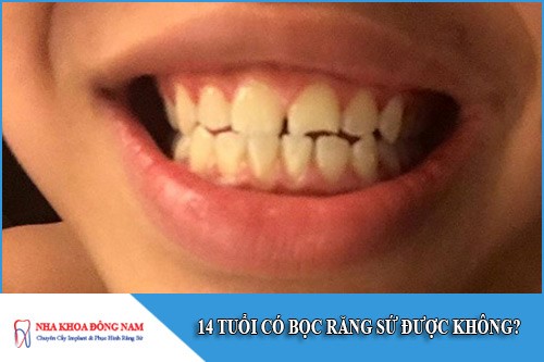 14 tuổi có bọc răng sứ được không