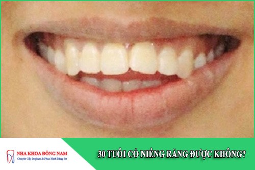 30 tuổi có niềng răng được không