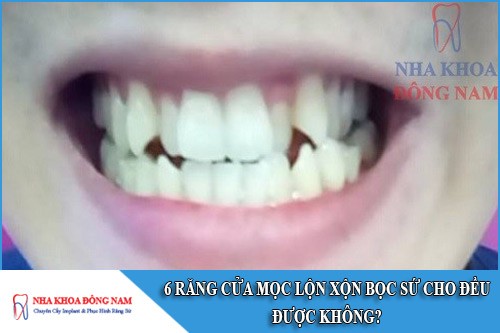 6 răng cửa mọc lộn xộn có bọc răng sứ cho đều được không