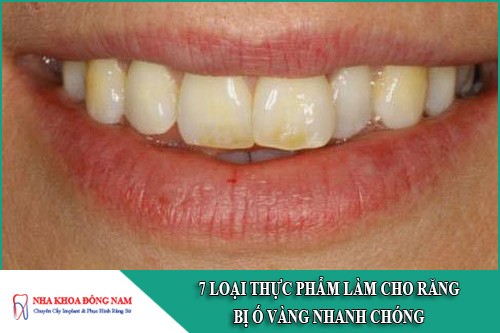 7 loại thực phẩm làm cho răng bị ố vàng nhanh chóng