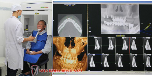 Chụp CT 3D Cone Beam là gì và có gây hại cho cơ thể không 2