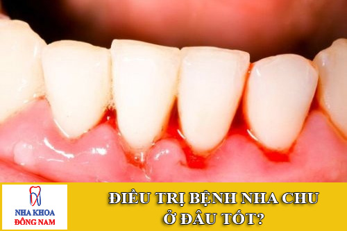 điều trị bệnh nha chu