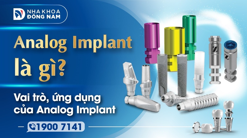 Analog Implant là gì vai trò và ứng dụng trong Implant