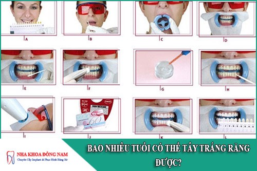 bao nhiêu tuổi có thể tẩy trắng răng được