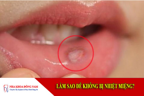 bệnh nhiệt miệng