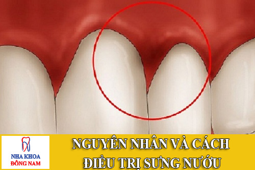 Nguyên nhân và cách điều trị bệnh sưng nướu