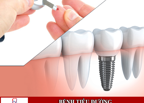 Bệnh tiểu đường trồng răng implant được không