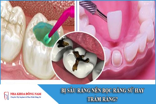 bị sâu răng nên bọc răng sứ hay trám răng