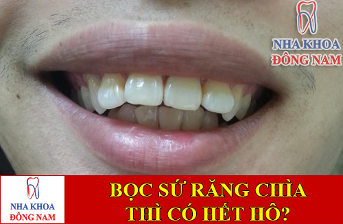 bọc răng sứ cho răng bị chìa thì có hết hô -1