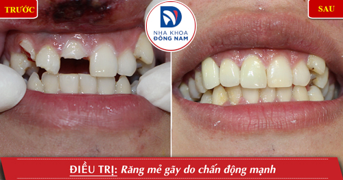 Bọc răng sứ cho răng mẻ gãy do chấn động mạnh