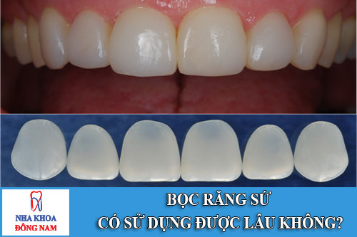 bọc răng sứ có thể sữ dụng được bao lâu
