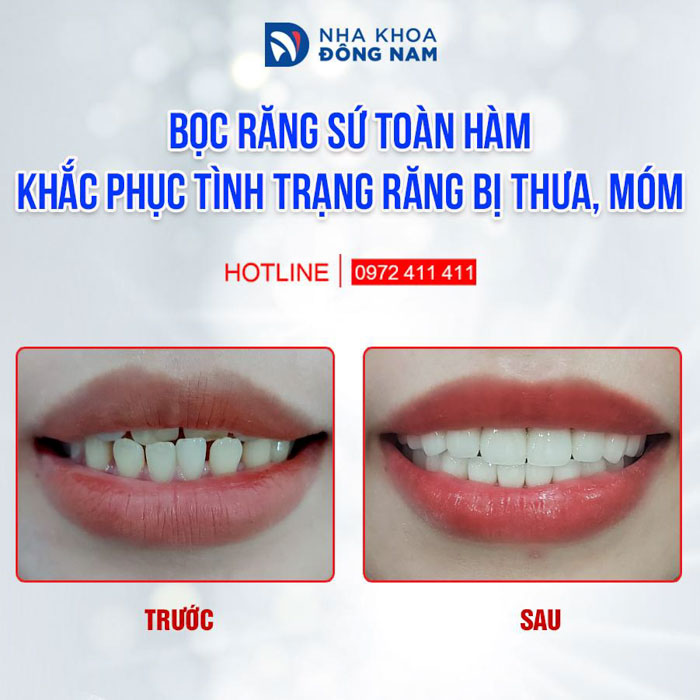 Bọc răng sứ đem lại thẩm mỹ tối ưu