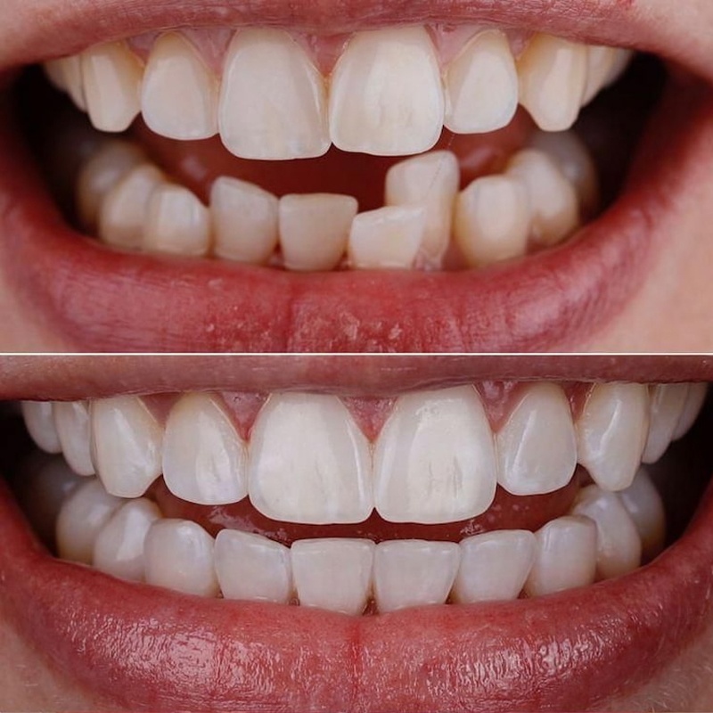 Bọc răng sứ khắc phục tình trạng răng thụt vào nhẹ