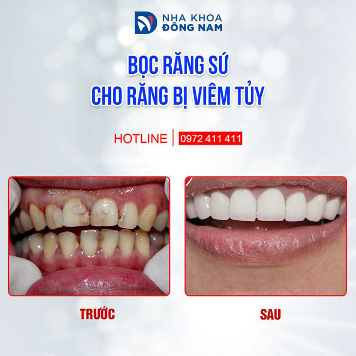 Bọc răng sứ khi tổn thương đã làm ảnh hưởng đến vùng tủy