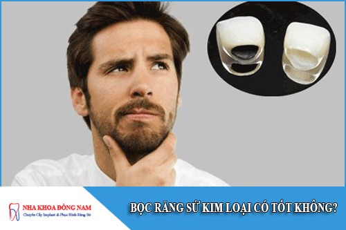 bọc răng sứ kim loại có tốt không