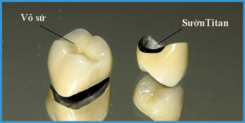 Răng sứ kim loại là gì? Lợi hại như thế nào???