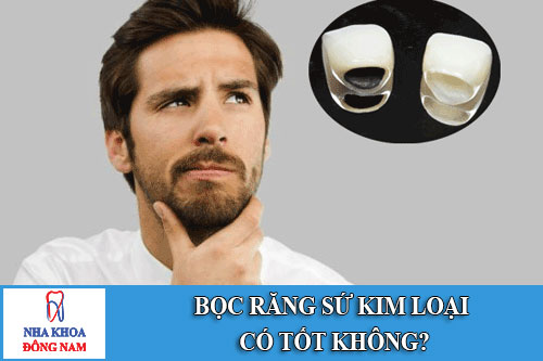 bọc răng sứ kim loại có tốt không