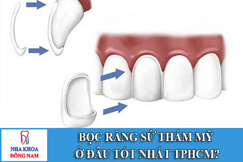 bọc răng sứ thẩm mỹ ở đâu tốt nhất tphcm
