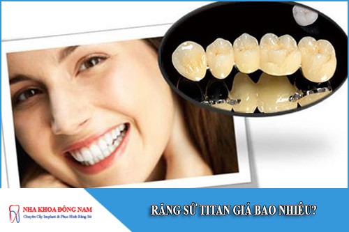 răng sứ titan giá bao nhiêu