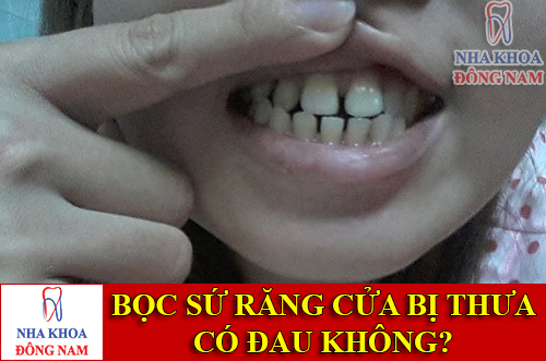 bọc sứ cho răng cửa bị thưa có đau không -1