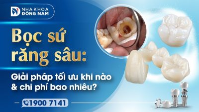 Bọc sứ răng sâu Giải pháp tối ưu khi nào & chi phí bao nhiêu?