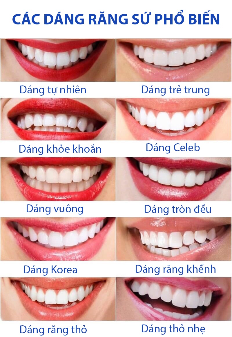 Các dáng răng sứ phổ biến