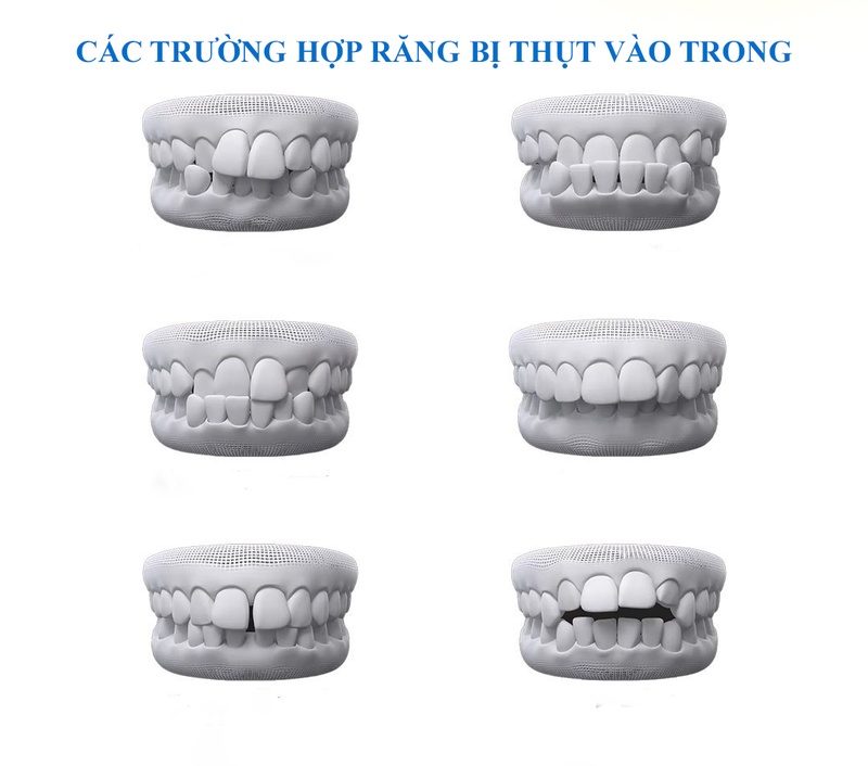 Các trường hợp răng bị thụt vào trong phổ biến