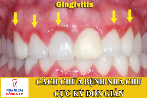 cách chữa bệnh nha chu cực kỳ đơn giản -1
