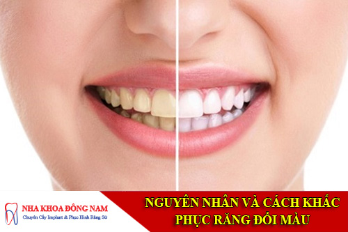 cách khắc phục răng đổi màu
