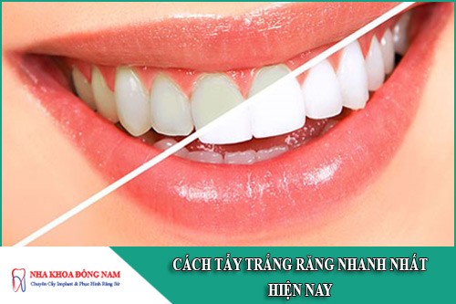 cách tẩy trắng răng nhanh nhất hiện nay