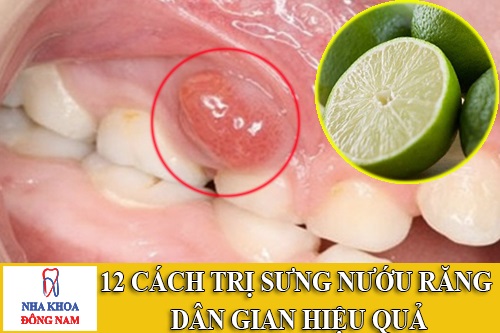 cách trị sưng nướu răng