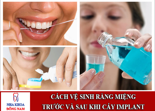 Cách vệ sinh răng miệng trước và sau khi cấy implant