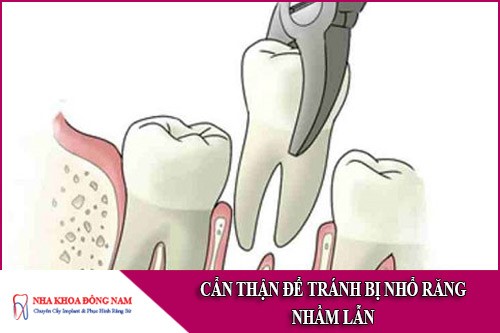 cẩn thận để tránh bị nhổ răng nhầm lẫn
