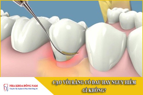 cạo vôi răng có đau hay nguy hiểm gì không