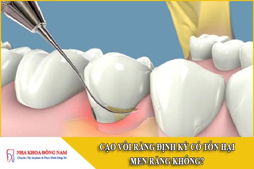 cạo vôi răng định kỳ có tổn hại đến men răng không