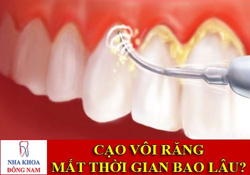 cạo vôi răng mất thời gian bao lâu thì xong -1
