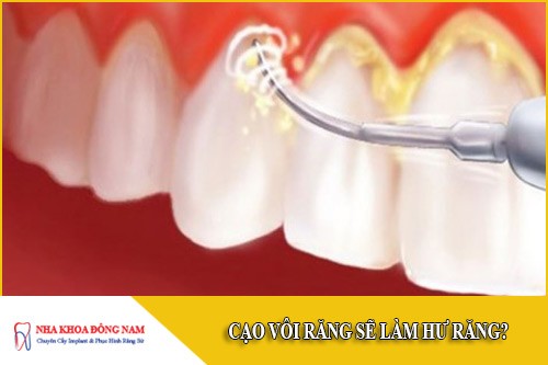 cạo vôi răng sẽ làm hư răng