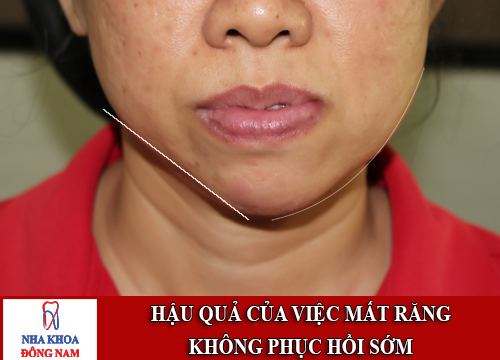 cấy ghép implant cho người mất nhiều răng