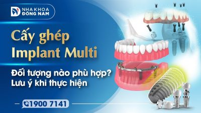 Cấy ghép Implant Multi