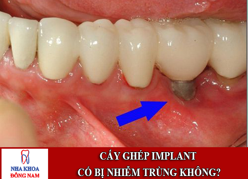 Cấy ghép implant có bị nhiễm trùng không