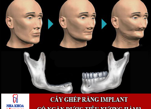 Cấy ghép răng implant có ngăn được sự tiêu xương hàm